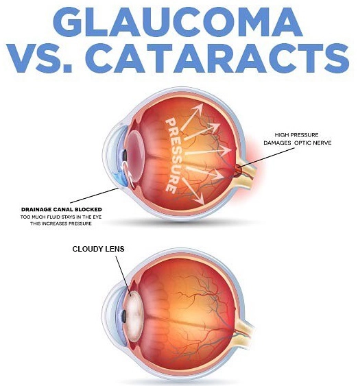 Glaucoma vs. Cataracts What Makes Them Different?